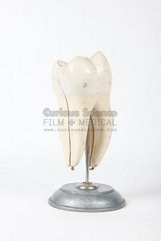 Model of decayed tooth